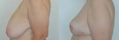 breast-reduction-lift9